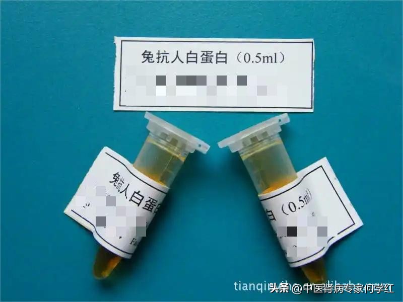 肾病综合症水肿是什么原因导致的,肾病综合症打了单抗水肿