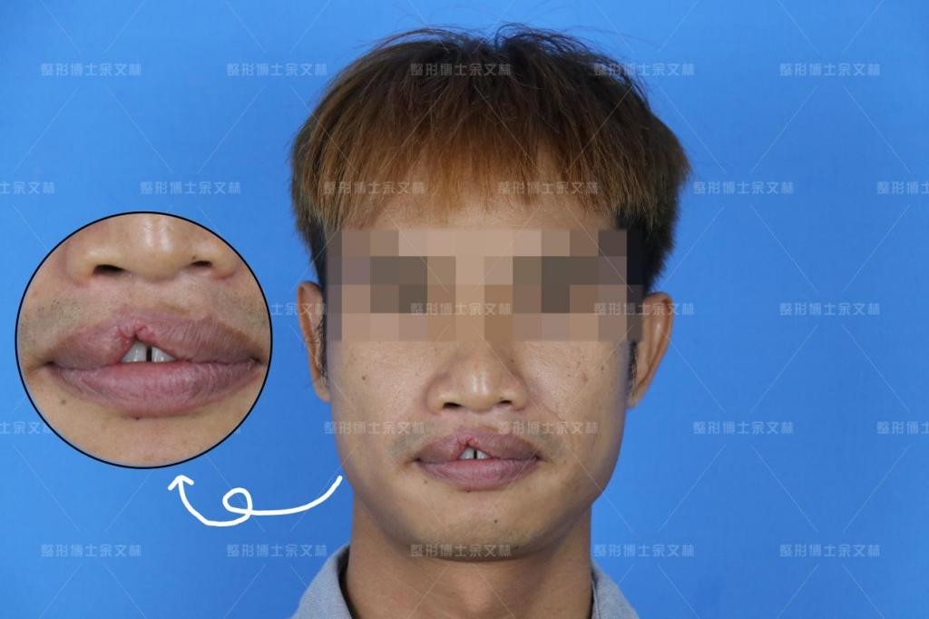 唇裂造成畸形牙矫正视频,唇裂缺陷怎么调理