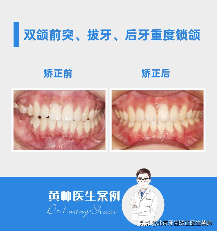 嘴凸的人怎么笑起来好看,嘴凸怎么让自己不焦虑