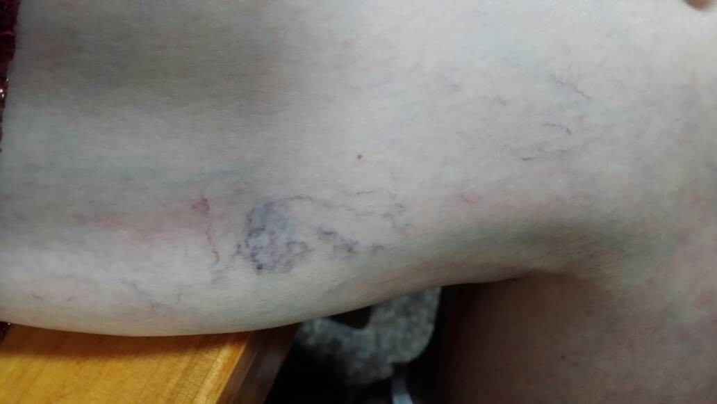 缓解静脉曲张简单实用不花冤枉钱,精索静脉曲张吃药能缓解疼痛吗