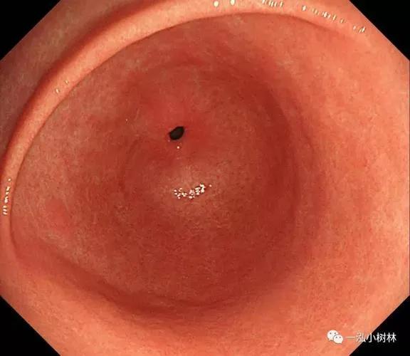 萎缩性胃炎英子,萎缩性胃炎的科普文章