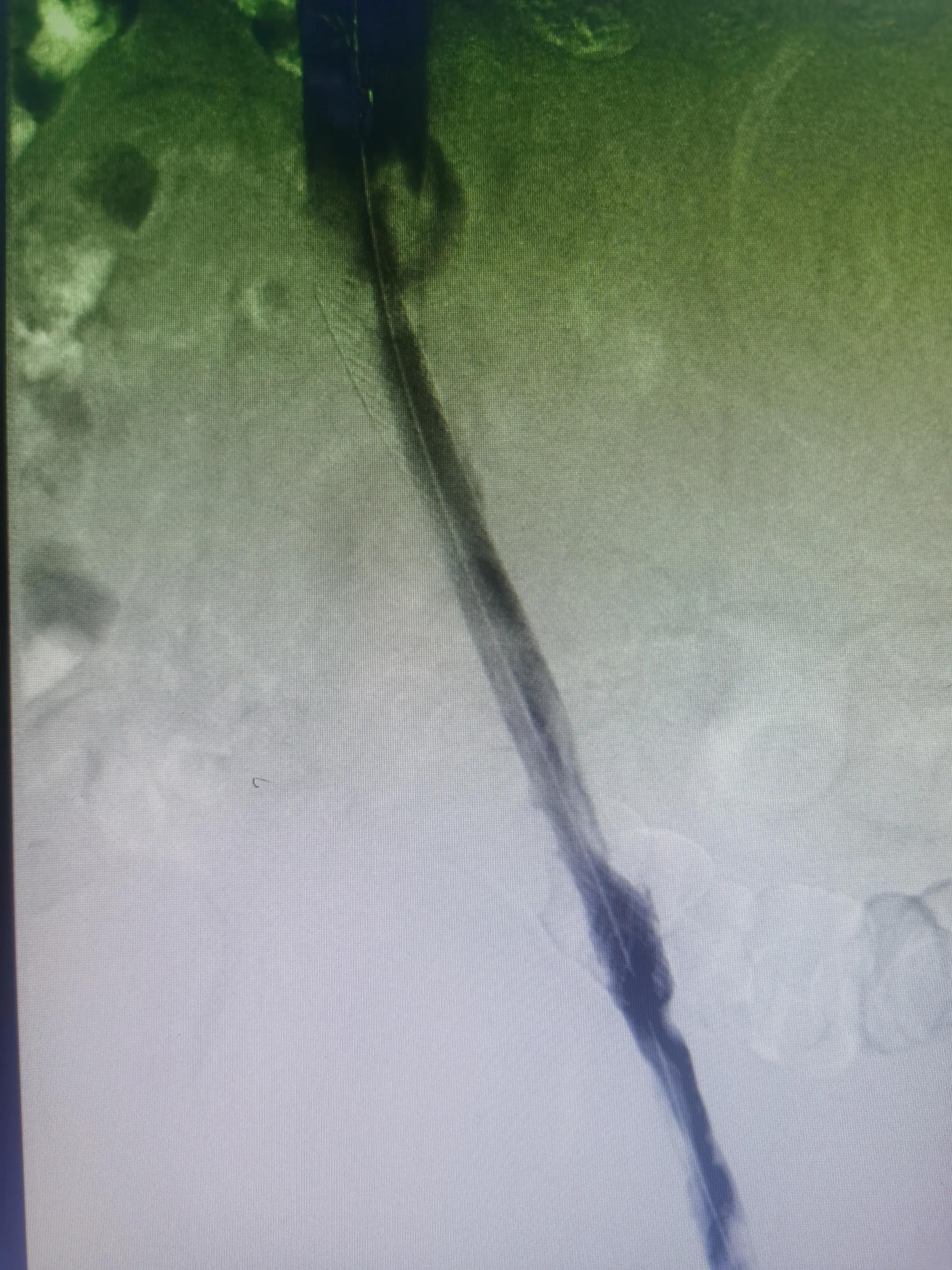 病人腿肿如何消除,病人腿肿了怎么回事