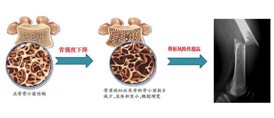 如何预防乳腺癌骨质疏松,乳腺癌内分泌治疗如何预防高血脂