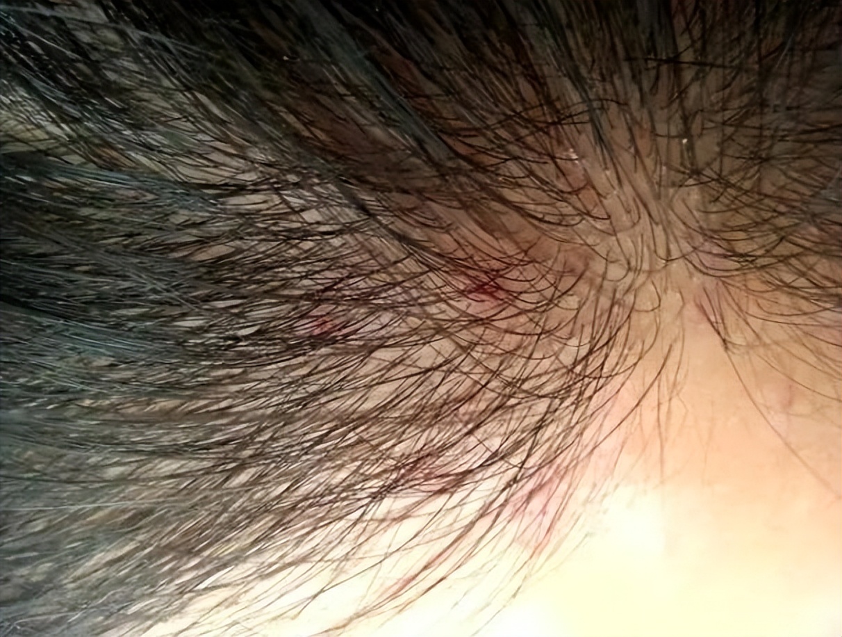 如何改善头皮长脓包和疙瘩的问题,头皮上总是长疙瘩和脓包如何根治