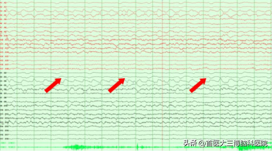 三博脑科医院脊髓外肿瘤手术,三博医院垂体瘤专家