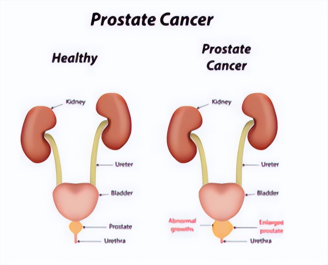 男性雄性激素越旺盛越好吗,男人50岁后雄性激素旺会脱发吗