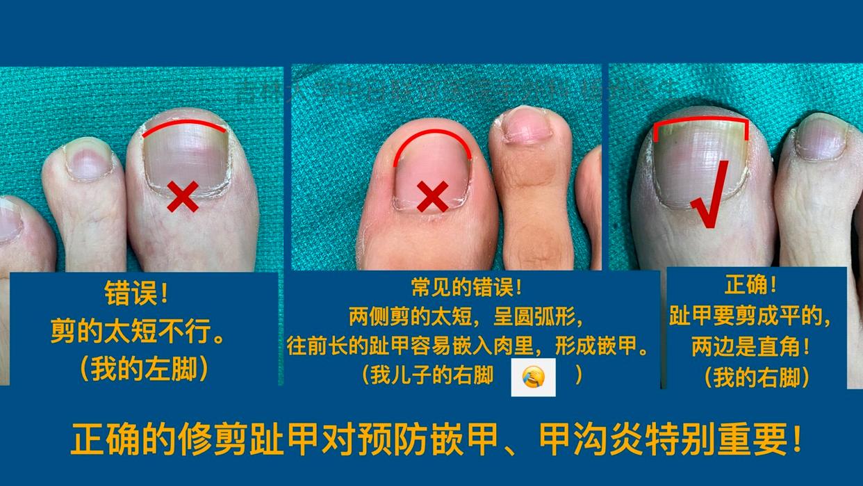 脚趾甲往肉里面长很疼算甲沟炎吗,脚趾甲老往肉里钻一碰还疼