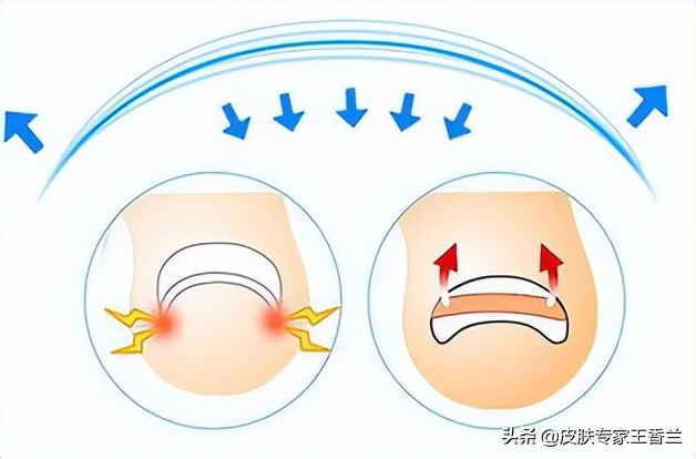指甲长进肉一碰就疼,指甲长进肉里特别深
