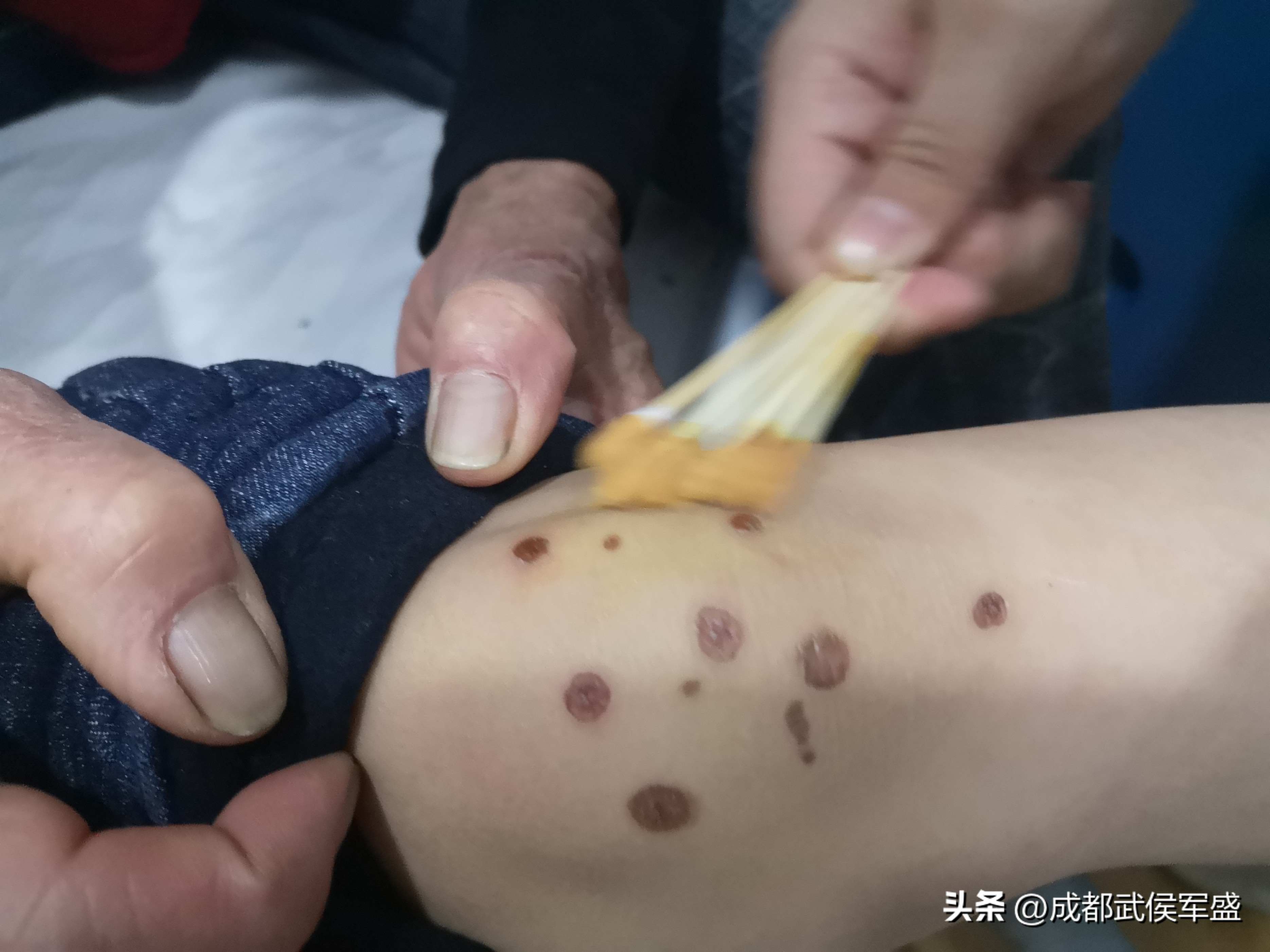 6岁男童被父亲烟头烫,癫痫发作被火烫伤的男孩