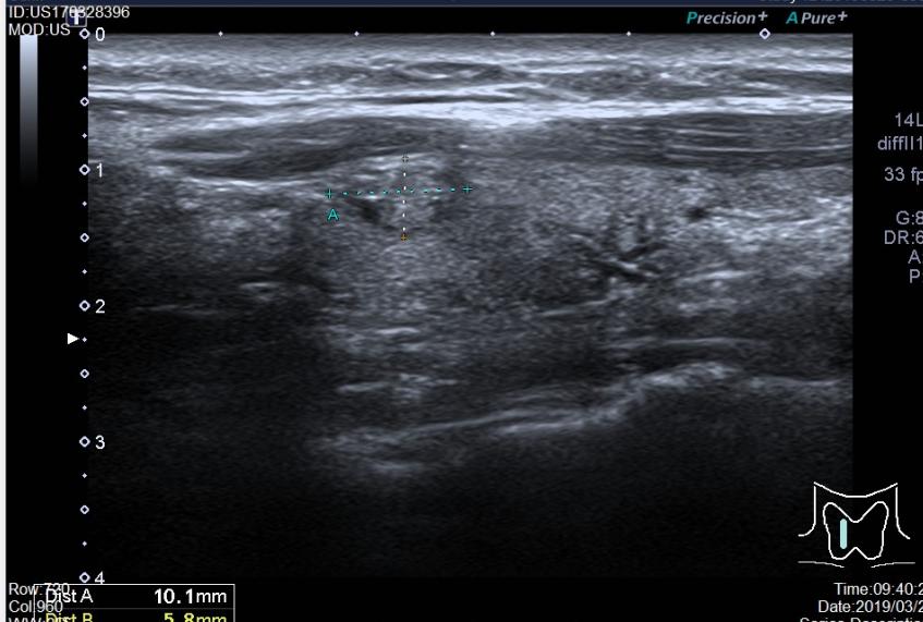 甲状腺结节消融术后饮食注意事项,甲状腺结节4a级饮食需要注意什么