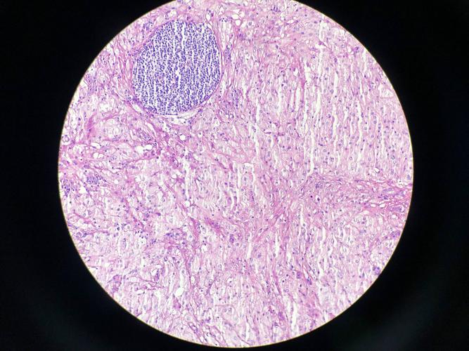 肾囊肿切除囊壁是大手术么,肾囊性占位一般是恶性的吗