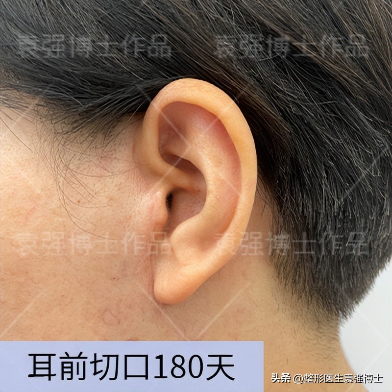 拉皮手术前后的感受,拉皮手术全面解答