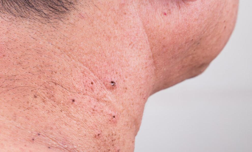 赵忠祥鳞状细胞癌什么症状,赵忠祥鳞状细胞癌有什么症状