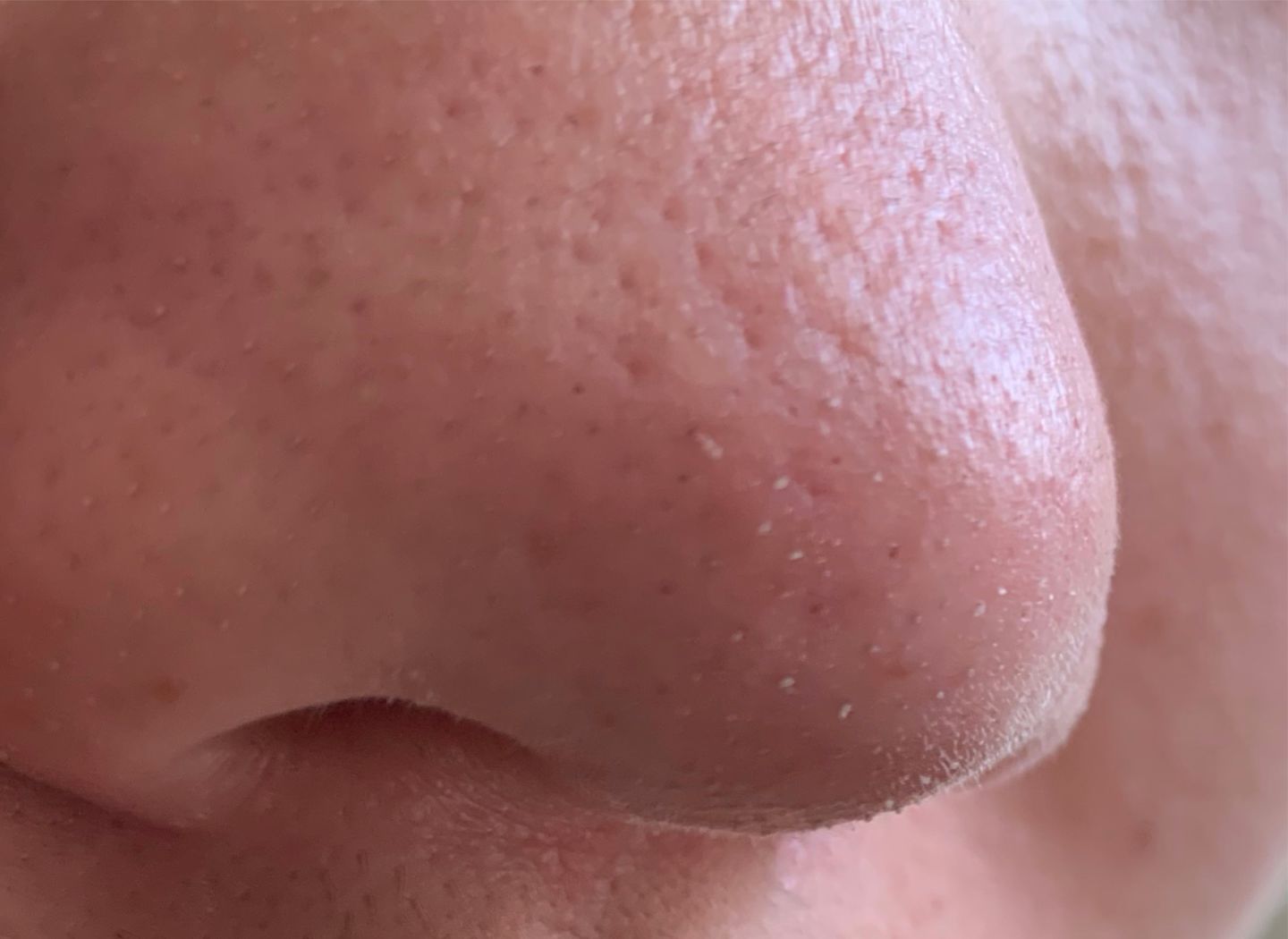 鼻子毛孔大能挤出好多脂肪粒,鼻子上长了像脂肪粒的东西