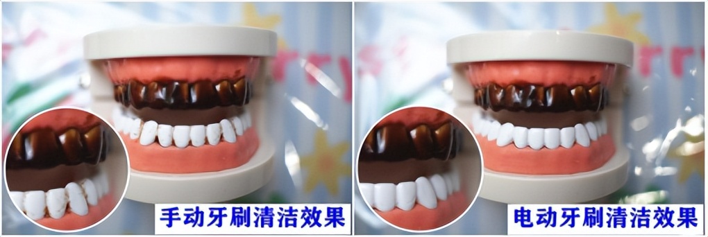 电动牙刷牙医推荐,牙医推荐的电动牙刷怎么样