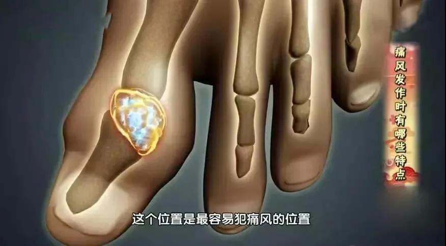 奖门人：关节炎为什么总在一个地方犯？掌握4招，减轻症状