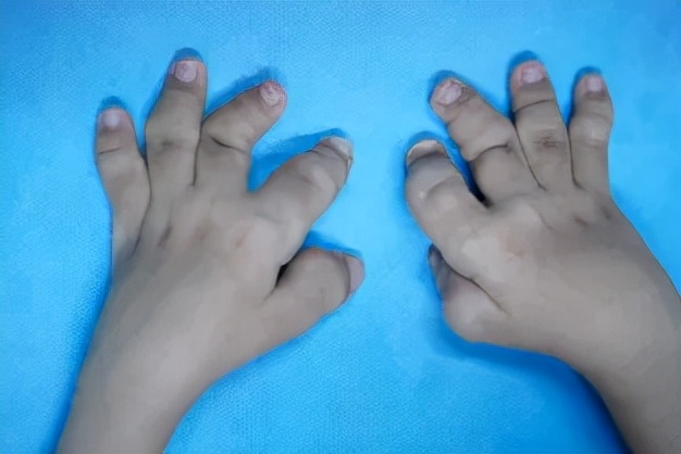 求医6年终确诊，她是全球第2例播散性黄瘤累及侵袭性关节炎