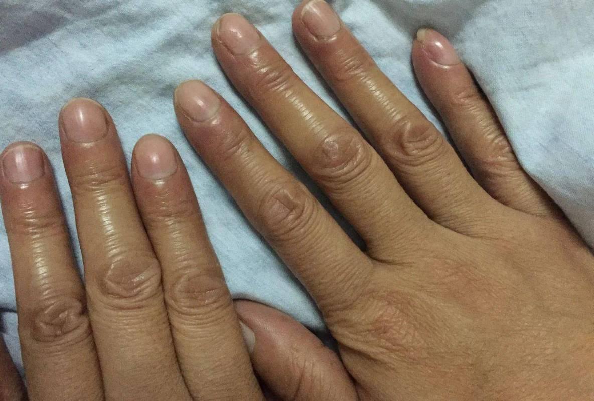 体内有癌皮肤先知提醒,体内有癌手部先知有三种表现