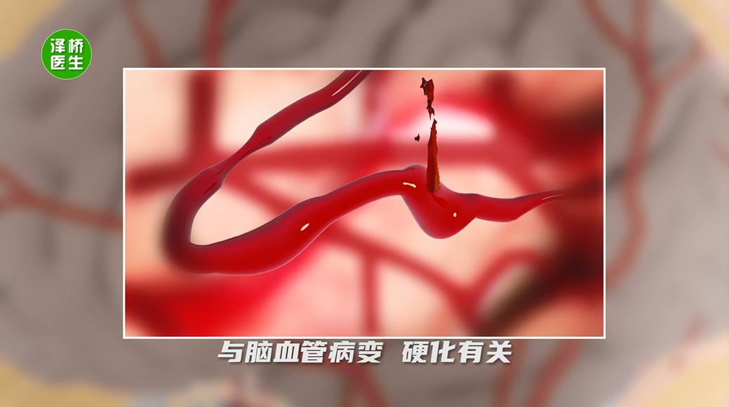 你以为的“累”，有可能是脑出血的前兆