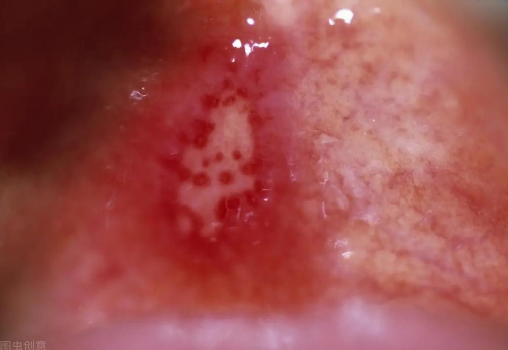 口腔溃疡到底是怎么回事,感冒后口腔溃疡怎么回事