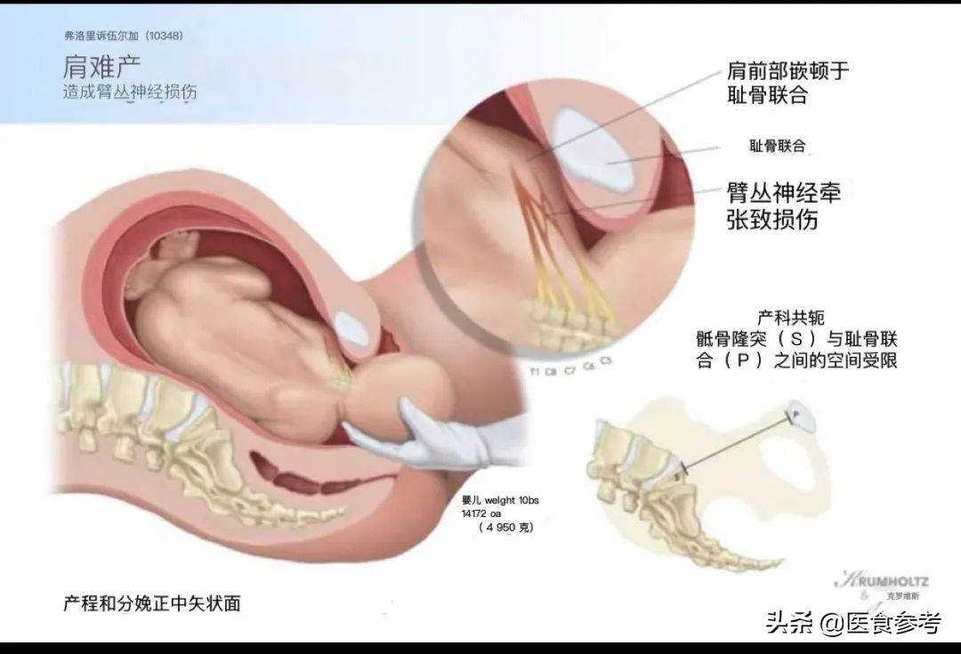 新生儿孩子臂丛神经被拔断,新生儿臂丛神经被拉断还能接上吗