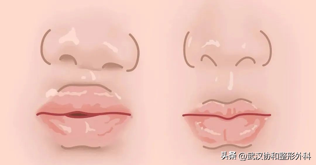 唇腭裂做一次手术就好了吗,唇腭裂一次性做完鼻子好吗