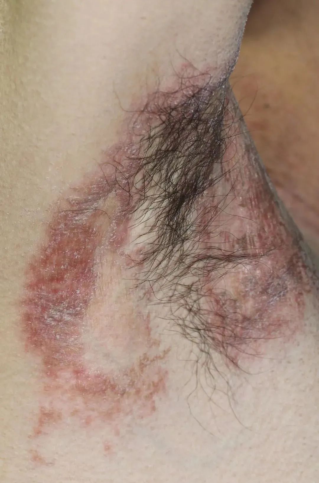 洗衣用消毒液出现皮肤不适,消毒液对皮肤瘙痒有作用吗