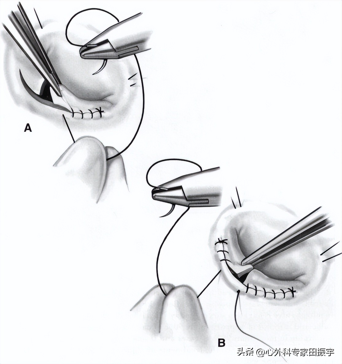 二尖瓣成形术要多少钱,二尖瓣成形术后抗凝多久