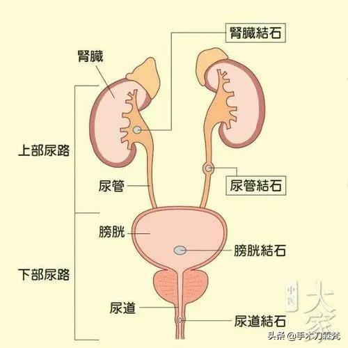 泌尿系结石注意什么,泌尿道结石吃什么中成药