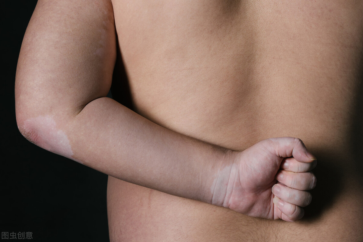 胳膊上有个小白点是白癜风吗,怎么治疗身上的白癜风白斑有效果