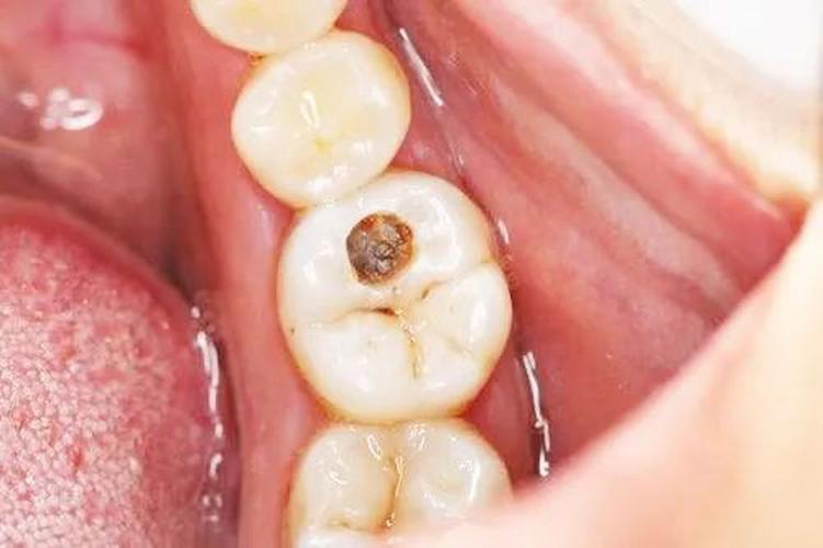 烂牙残根不拔的危害大吗,有没有治坏牙的好方法