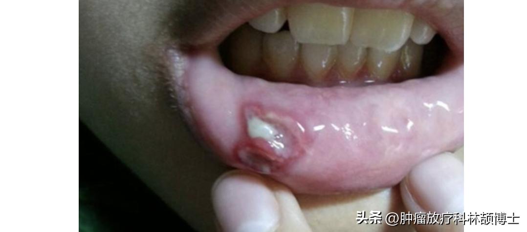 口腔溃疡反复发作颊癌,一直长口腔溃疡警惕癌