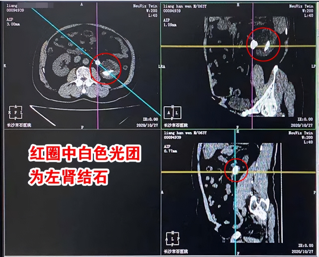 彩超和ct查结石哪个准确,做彩超可疑结石有必要做ct