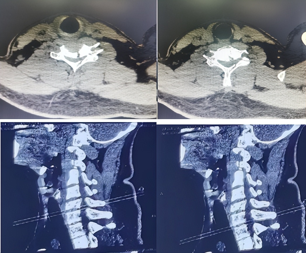 120紧急救援落石砸伤男子,紧急救援男人被电梯压死