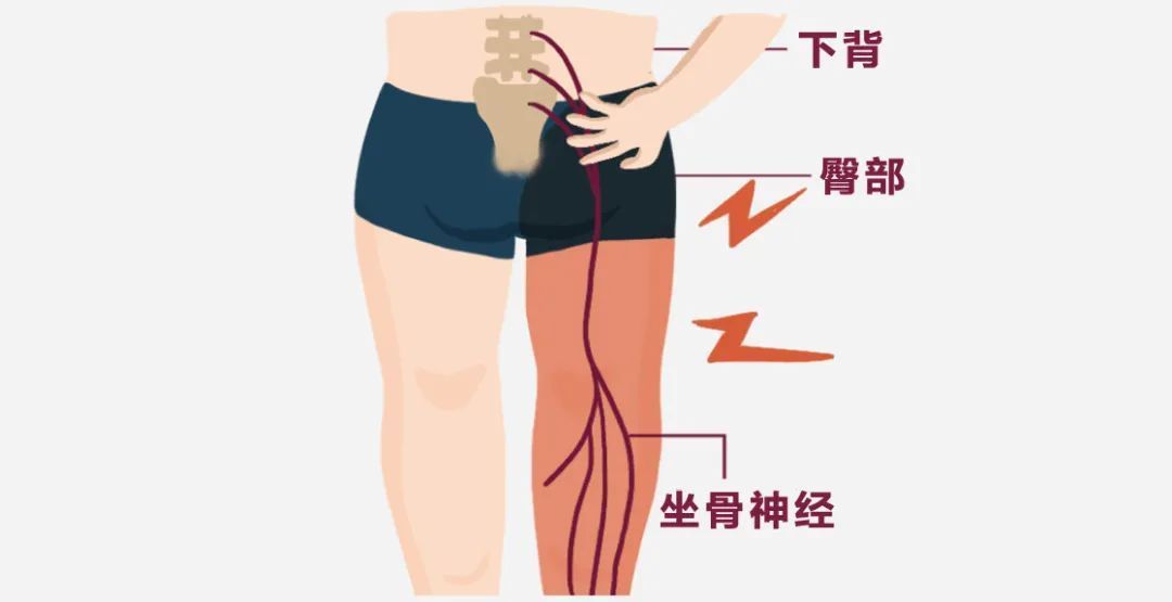 孕期缓解坐骨神经痛的最佳动作,腰椎间盘突出坐骨神经痛康复动作