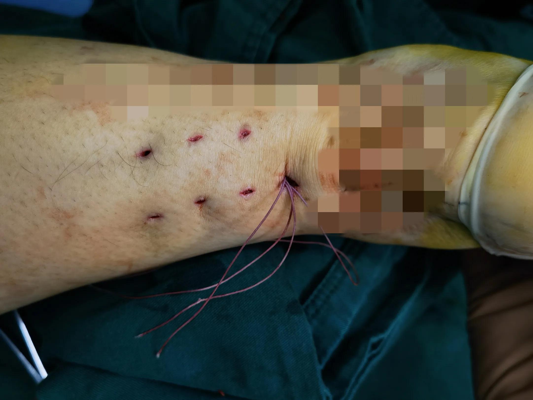 跟腱断裂的微创治疗,跟腱断裂微创手术修复演示图