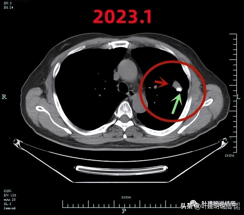 pet判断淋巴结转移,petct判断癌有没有转移准确吗
