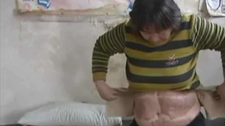 割皮救子父亲康复情况,儿子刚出生为弟弟捐骨髓后续