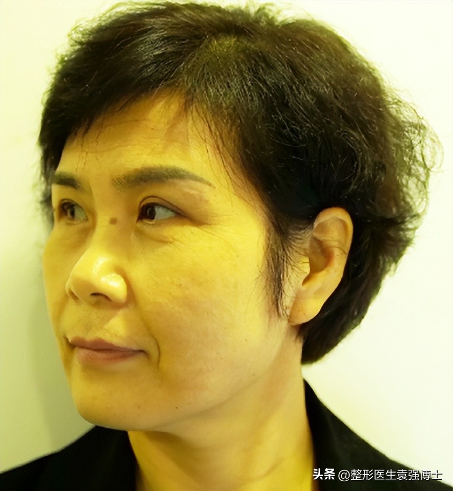 48岁瞒着家人来京做大拉皮，10天过去了，脸恢复成这样
