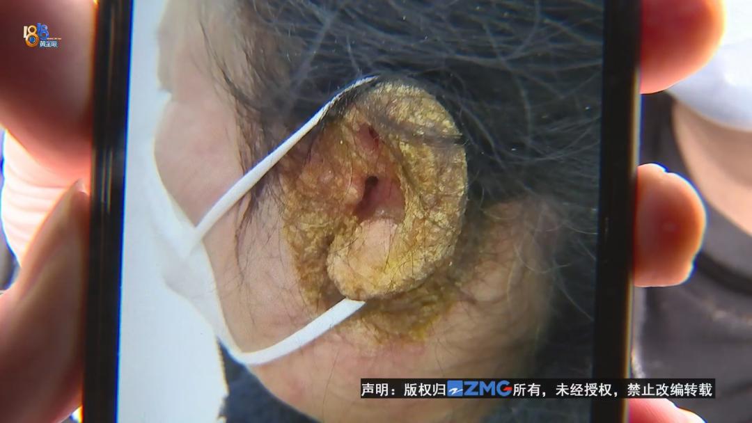 湿疹打针能好吗,湿疹用蛋白埋线效果不如两支药膏