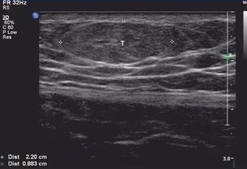 为何脂肪瘤总是长在身体左侧,身体上长满了脂肪瘤该怎么办