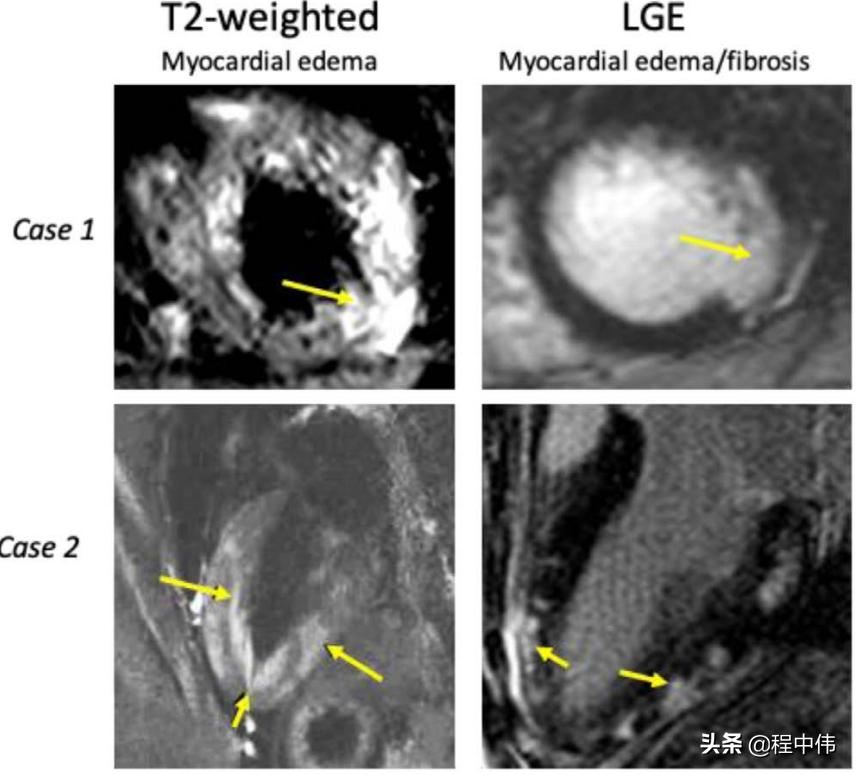 暴发性心肌炎及时发现治疗,最新病毒性心肌炎指南