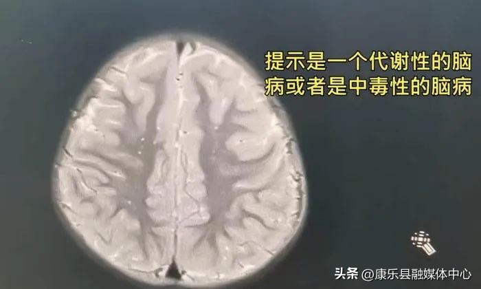 4岁孩子发烧导致孩子住进icu,7岁女童反复发高烧4天无任何症状