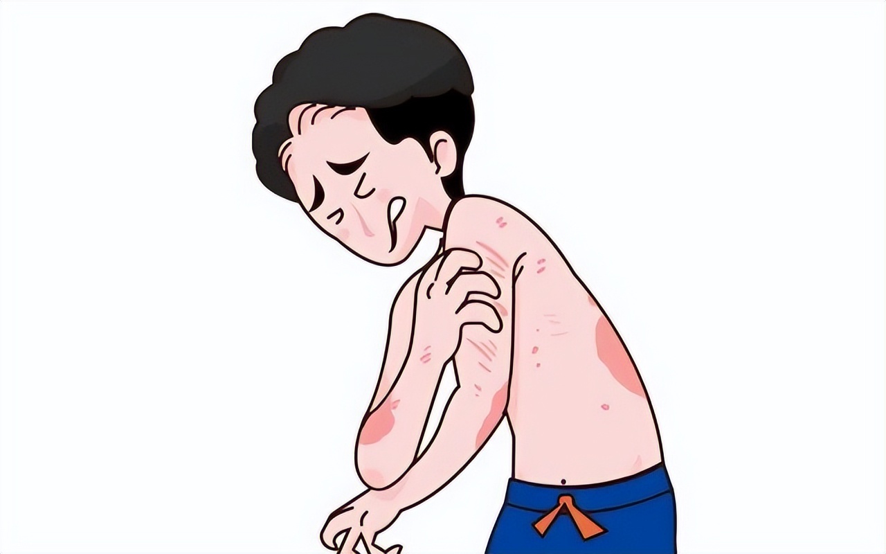 银屑病易与哪些皮肤病混淆,银屑病在人群中的比例