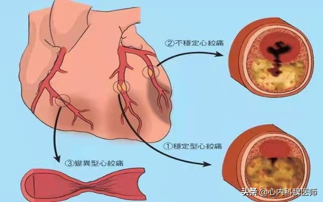 心肌缺血吃什么药效果更好,心肌缺血吃什么药效果比较好