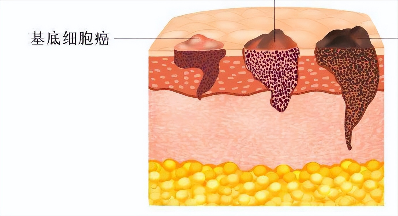 怎么判断鼻子上的痣是基底细胞癌,鼻头上黑头变成痣会癌吗