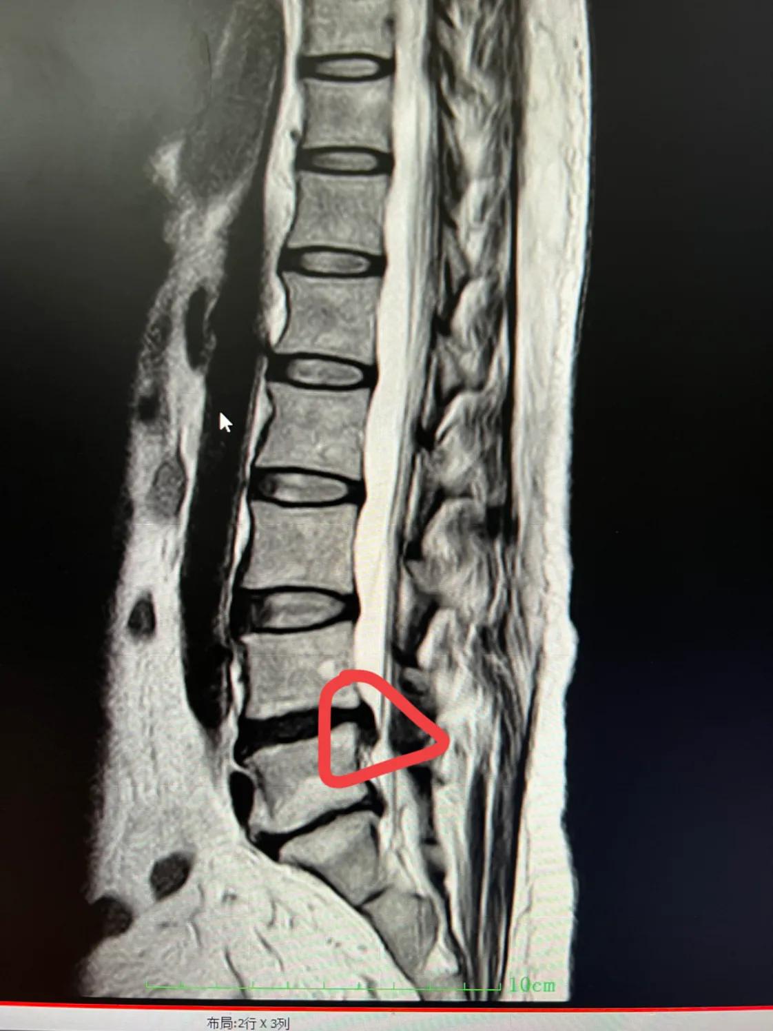腰椎间盘突出别人问好了没怎么说,椎间盘突出有网上说的那么严重吗