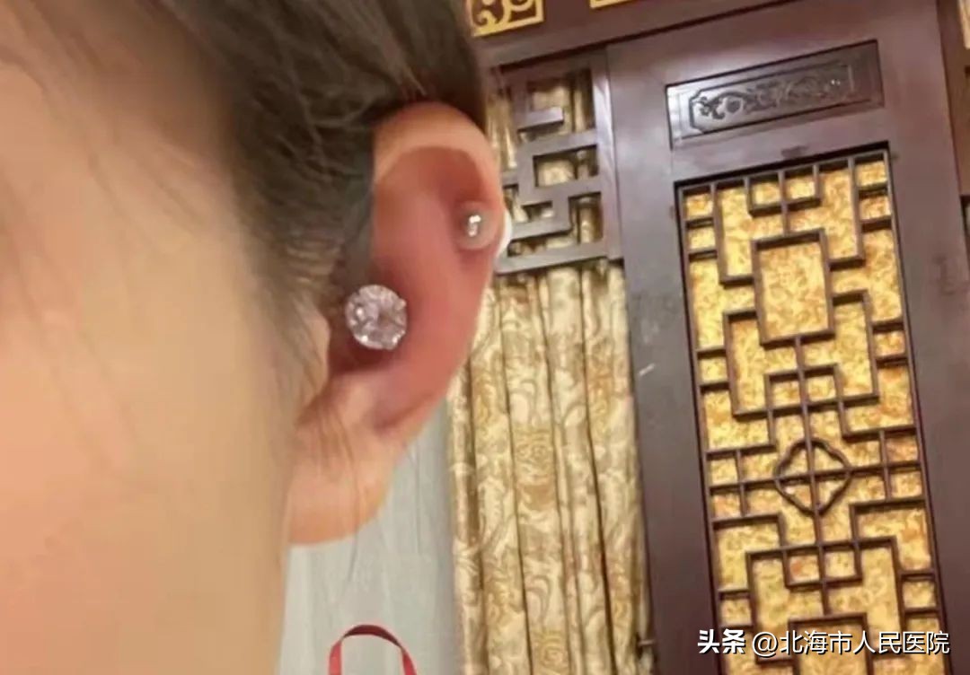 女子打耳洞导致颅内感染,女子打耳洞后红肿未留意