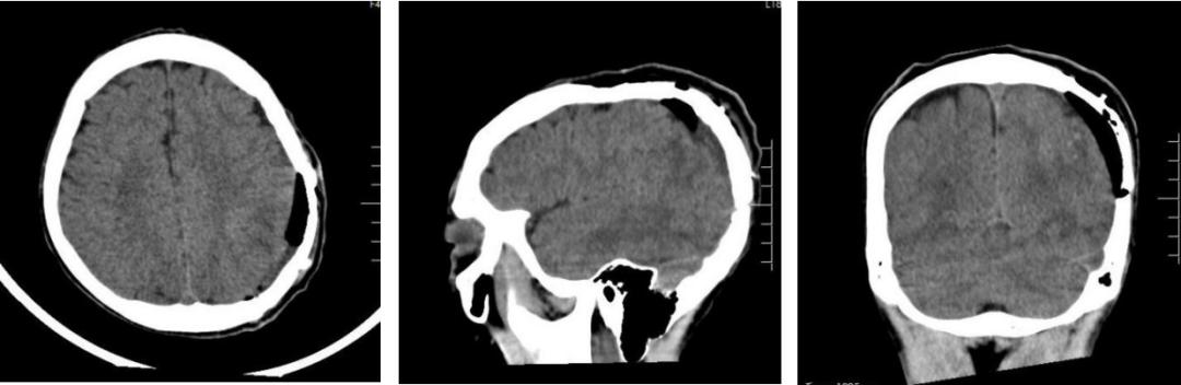 飞来横祸轮胎砸中脑袋,一男孩被铅球砸严重骨折