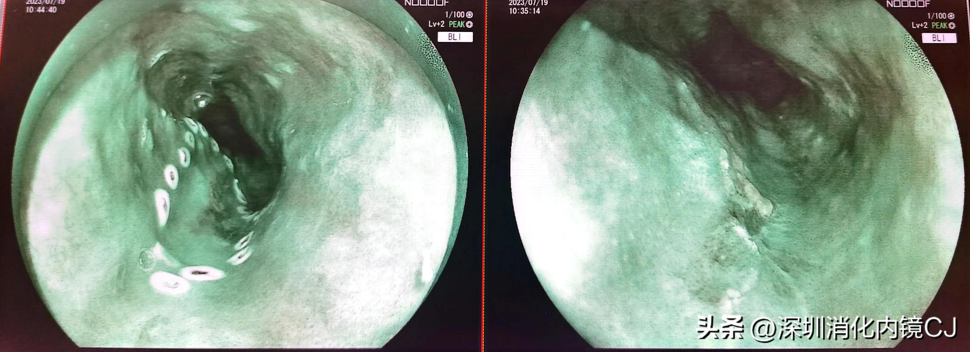 69岁及时发现食管癌，内镜下微创根治，避免了外科开胸手术